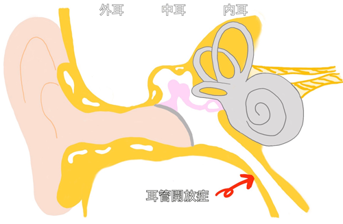 耳管開放症とは